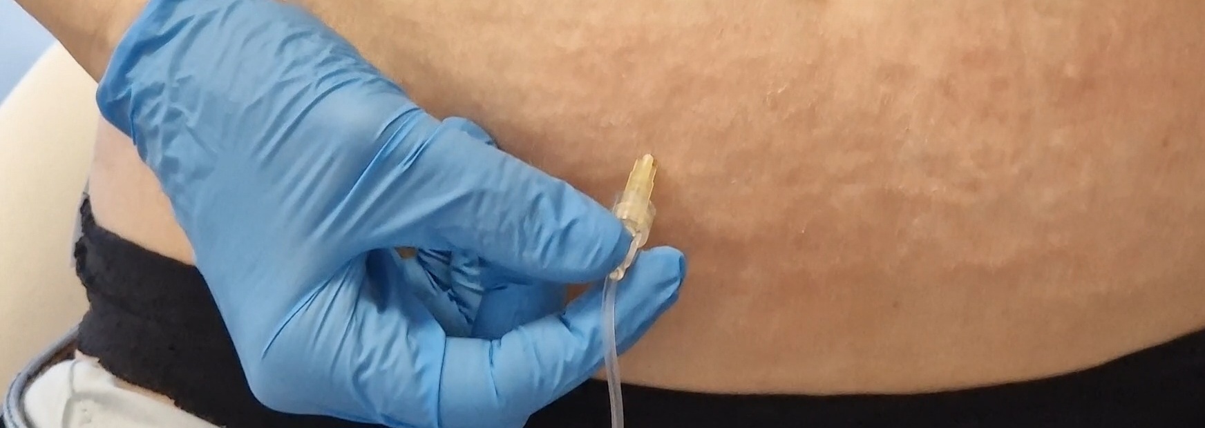 Zdjęcie osoby nakłuwanej podczas zabiegu